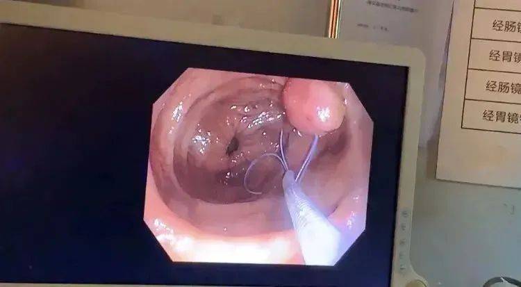 绒毛状|宁波博仕胃肠：肠息肉切除后不复查，3年后变成了晚期肠癌…