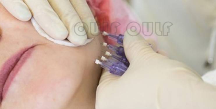 分析专业分析:蛋白线埋线一根多少钱?胶原蛋白线这个价格贵不!靠谱吗