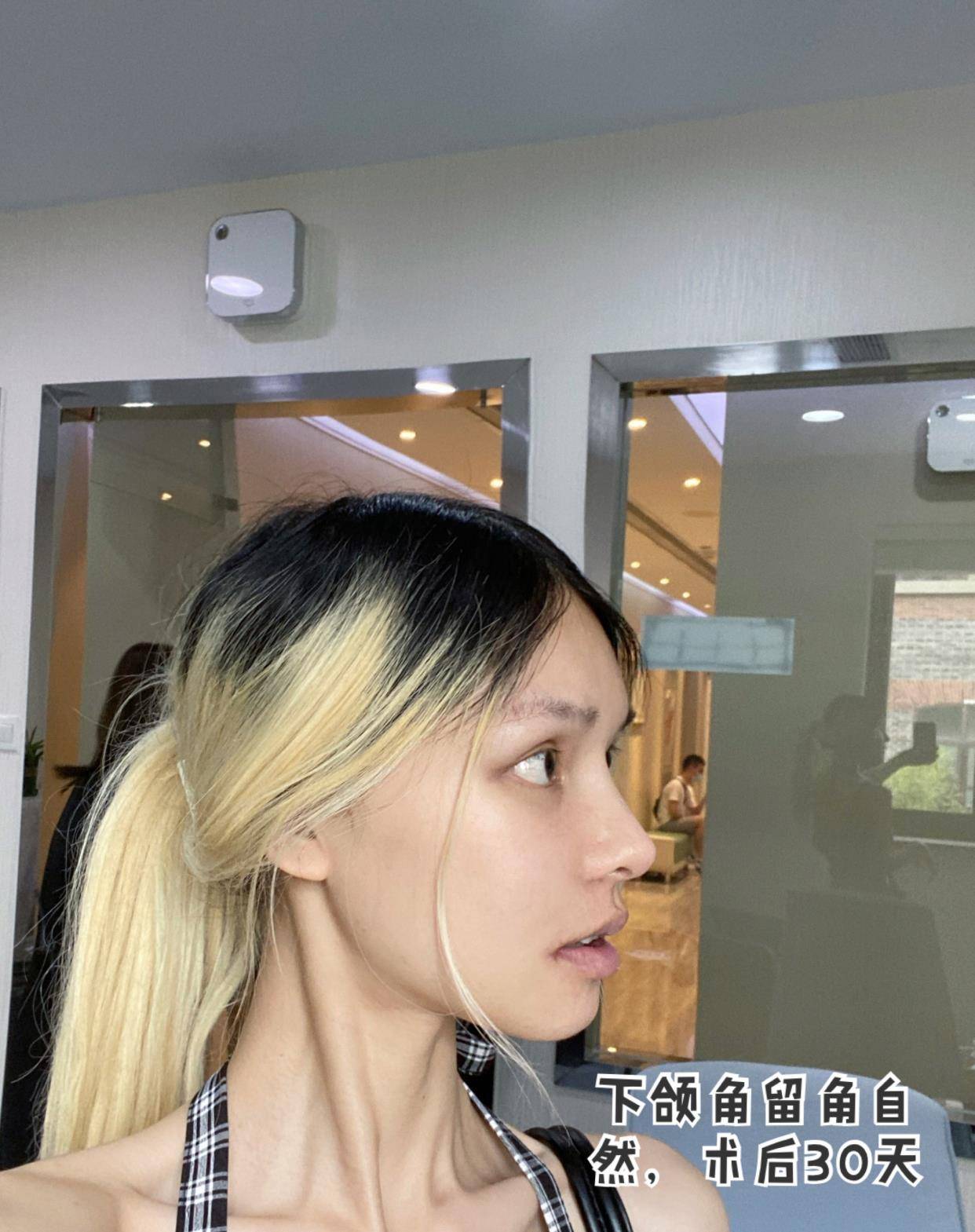 设计做下颌角到底留角or不留角？