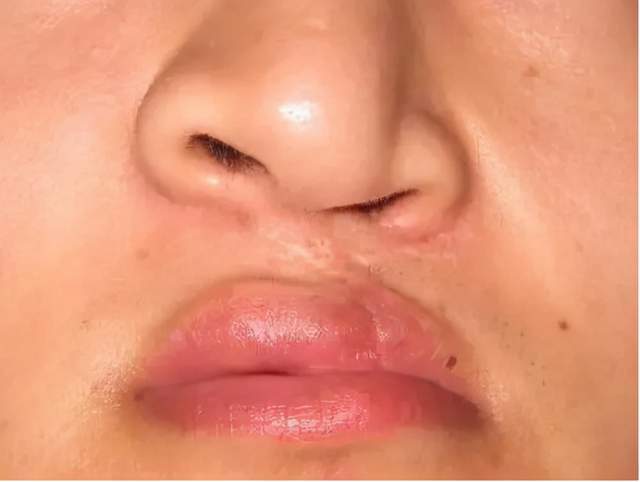 唇裂鼻畸形通常表现为患侧(唇裂侧)鼻孔宽大畸形,鼻基底塌陷,鼻小柱及