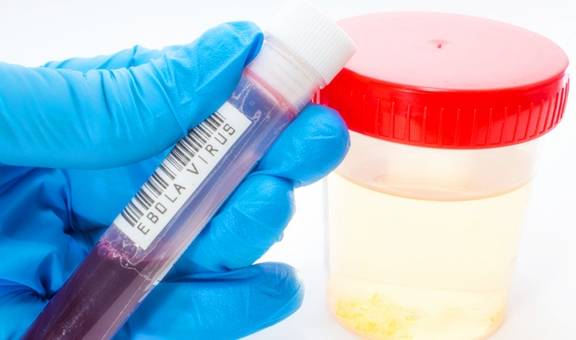 控制|糖尿病患者的尿又黄又骚是什么原因？你真的知道吗？看专家的理解