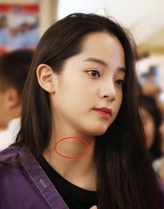 颈部明星都躲不掉的颈纹该怎么消除？
