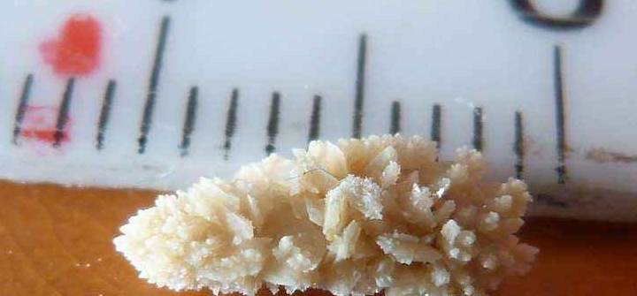 方法|左肾下盏有5mm x 7mm的肾结石，如何治疗效果好？