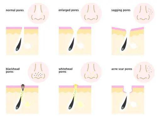 黑头别再瞎去挤黑头了！不仅伤害皮肤，“草莓鼻”还更明显！
