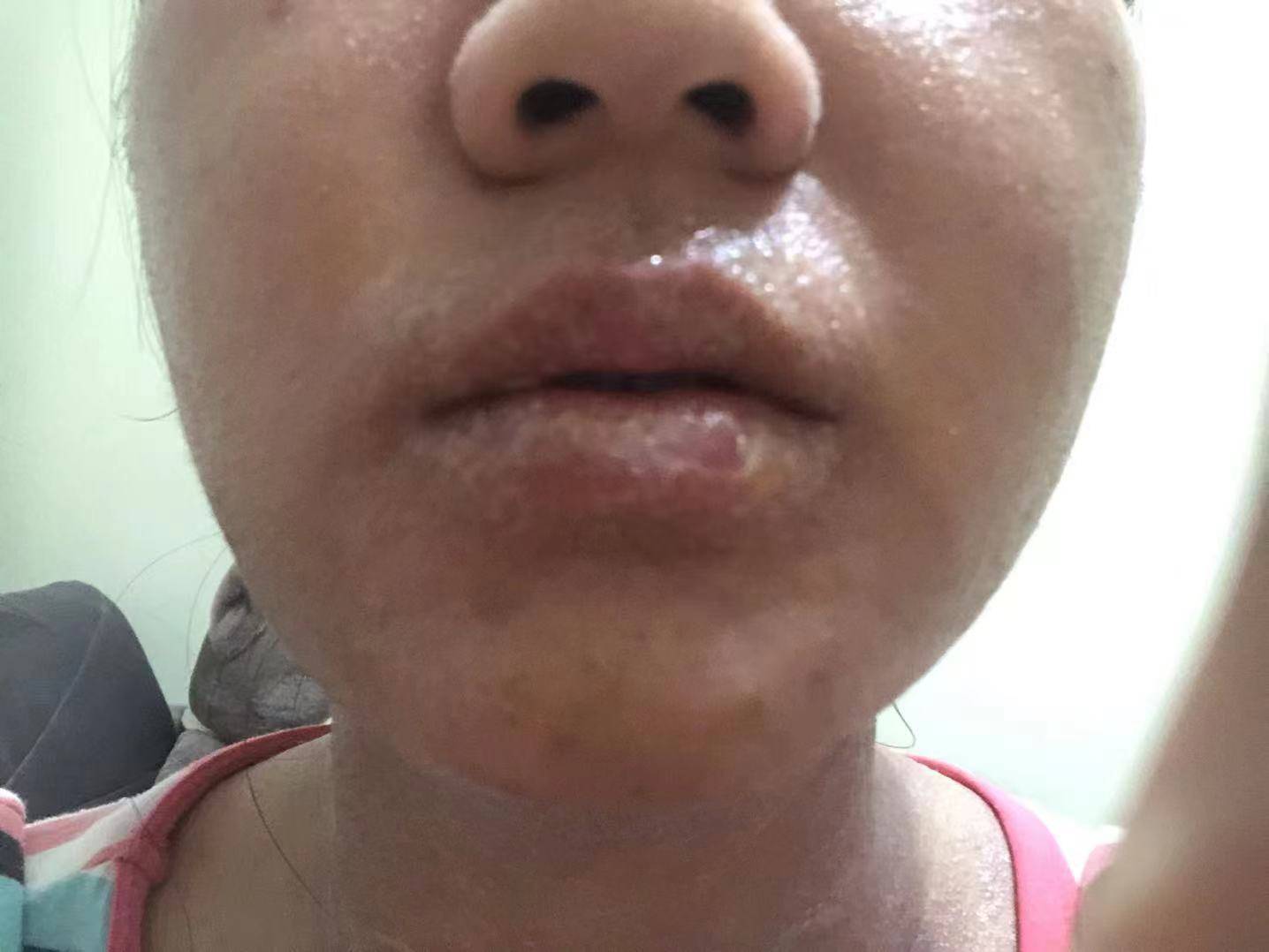 治疗华纳药业：使用葆肤安、懒人露、夜膏后，皮肤状况？