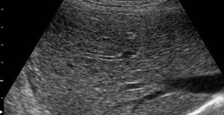 肝脏|从肝病的角度看，右上腹疼痛一般是什么原因？应该如何应对？