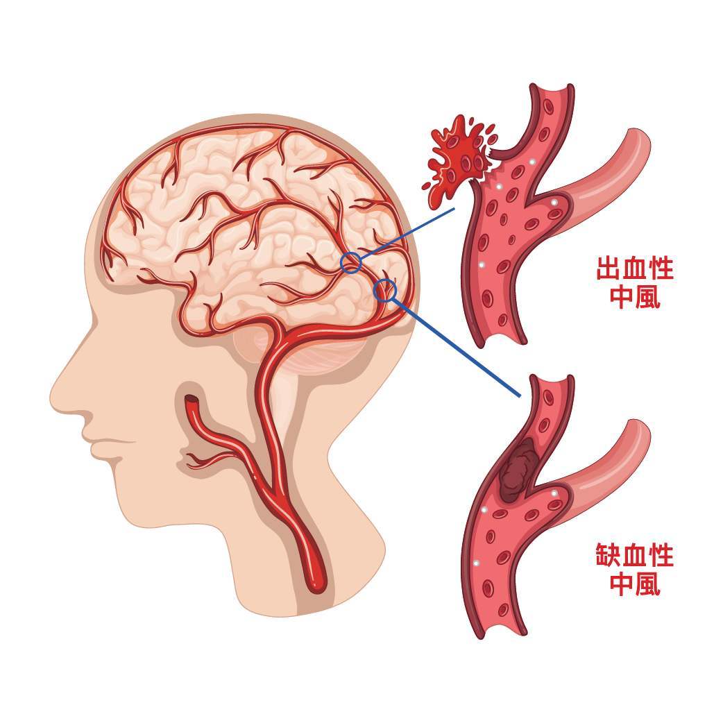 腦中風有幾種 要看哪一科呢 臺北神經醫學中心