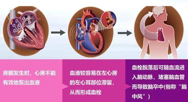 治疗|“心跳加速小鹿乱撞”是爱情来了？专家：想啥呢，很可能是“心病”！
