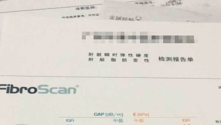 hbv-dna|48岁查出肝损伤,一年后发现早期乙肝肝硬化,早期肝硬化能治好吗