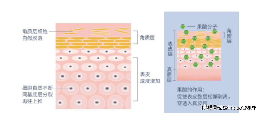 人群油痘肌必看刷酸原理，让你远离痘痘