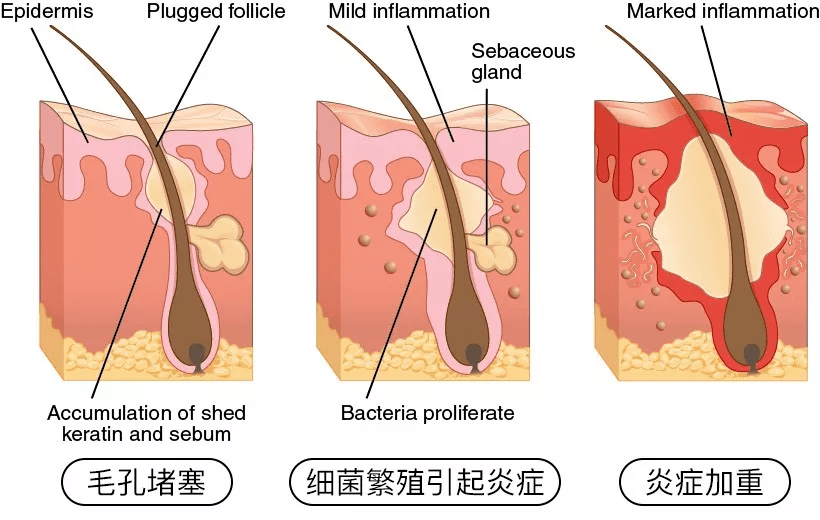 长痘痘这些祛痘误区，你有没有踩雷？为什么长痘？怎么避免长痘？