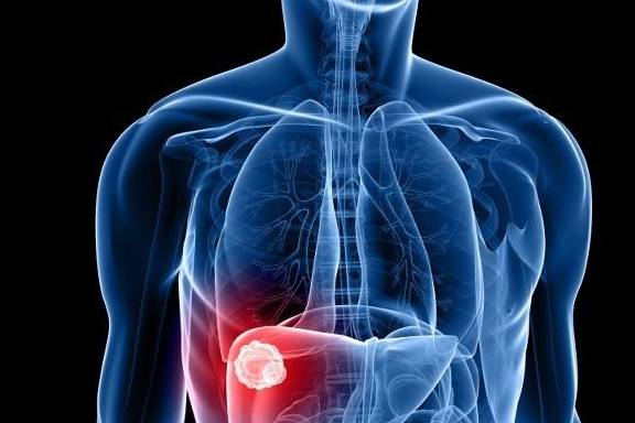 治疗|治肝癌没有“特效药”,关注这3点,对治疗或许有帮助