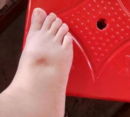 肾脏|血糖高的人，身体3个表现，若占1个，可能肾脏受损