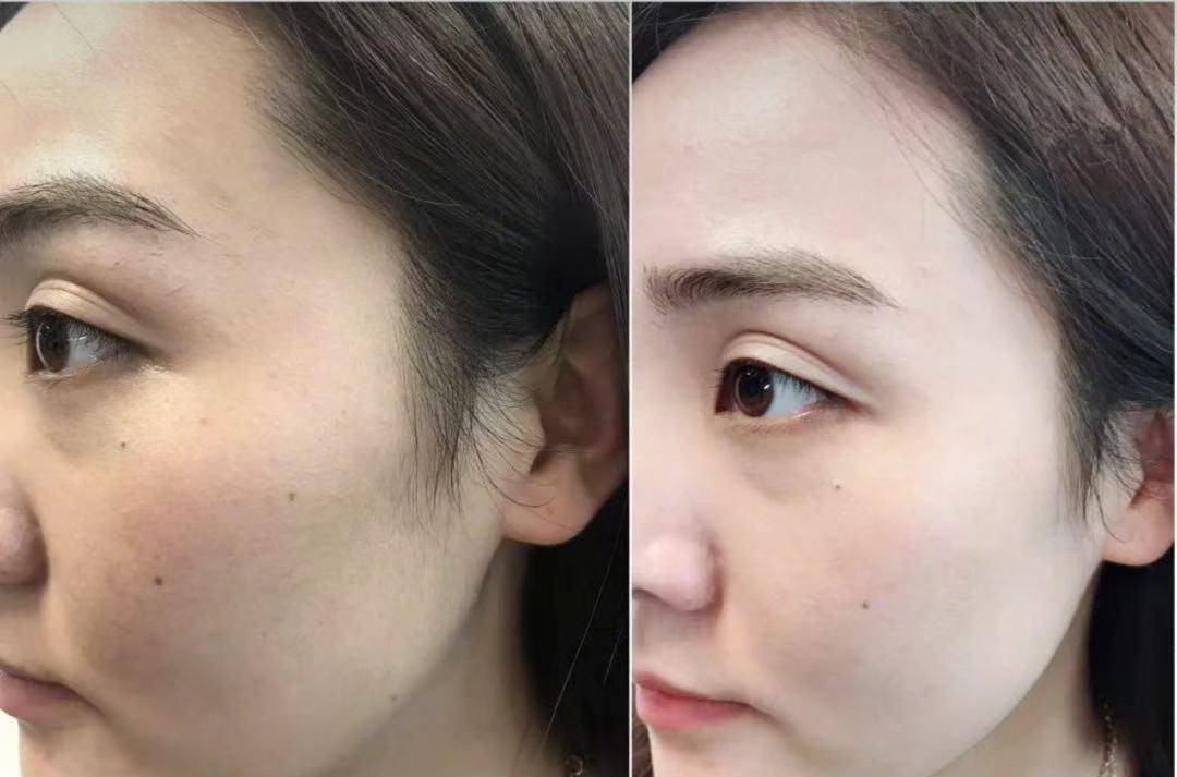 包文婧邓紫棋晒出一款祛斑乳膏，因价格便宜被忽视，用后斑斑点点消失了
