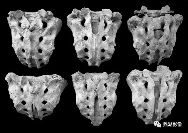 骶椎隐裂的分类和分型,快来了解一下吧!_spina