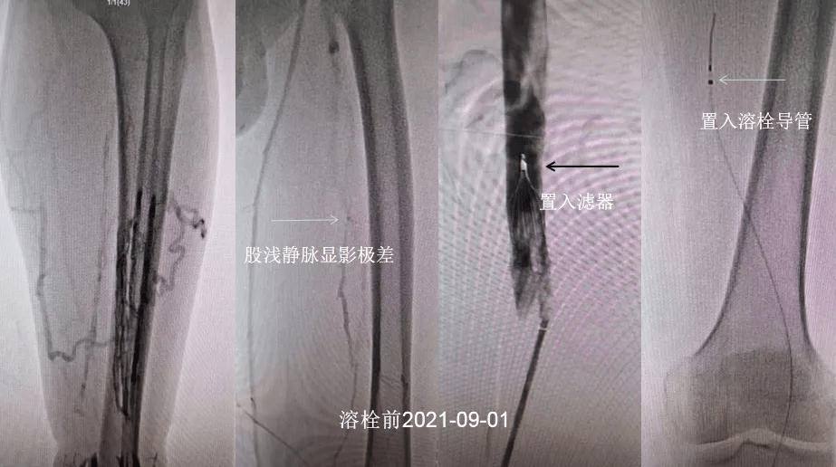 静脉|“沉默的杀手”——深静脉血栓（DVT）