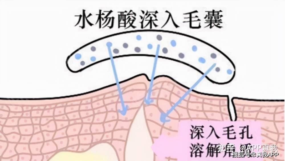 水杨酸用后爆痘怎么办