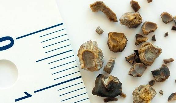 治疗|检查出肾结石?日常做到5件事,有助于“排石”