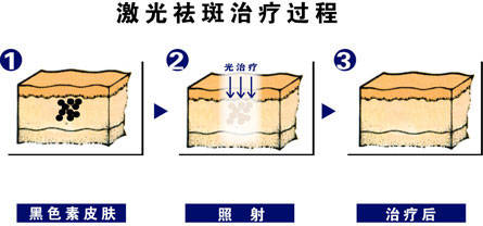 方法雀斑和黄褐斑有哪些区别？哪个年龄段容易长斑？怎么祛斑？