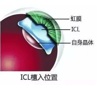 icl晶體植入到眼內後放置在位於虹膜之後,晶狀體之前的睫狀溝處,非常