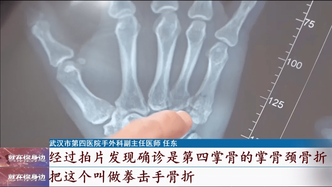 辅导|心疼！父亲教训贪玩的儿子，结果手掌骨折，竟是因为辅导作业……