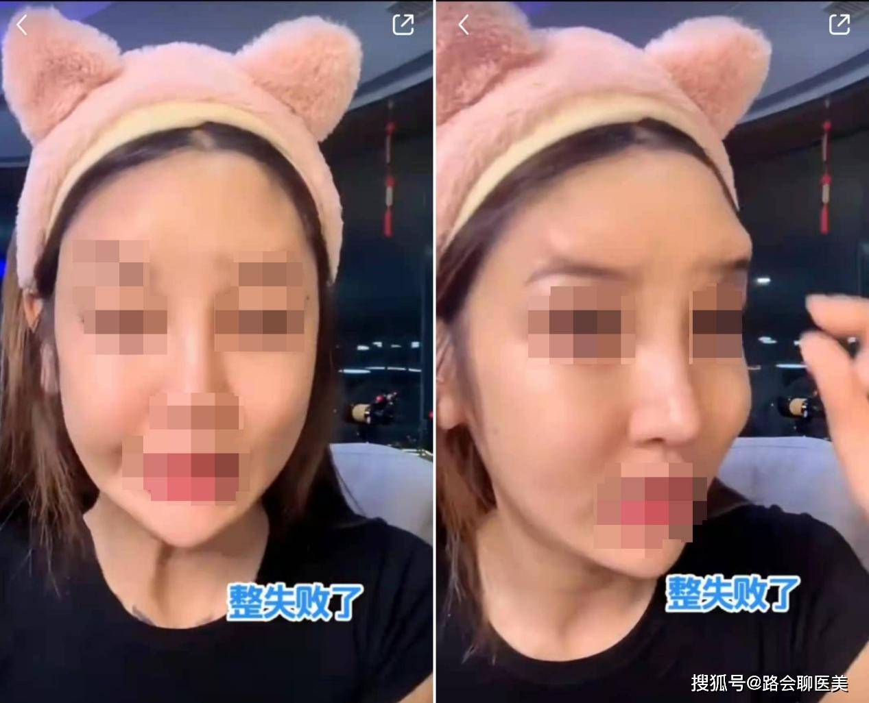 血管想做玻尿酸填充，看完这篇不走弯路