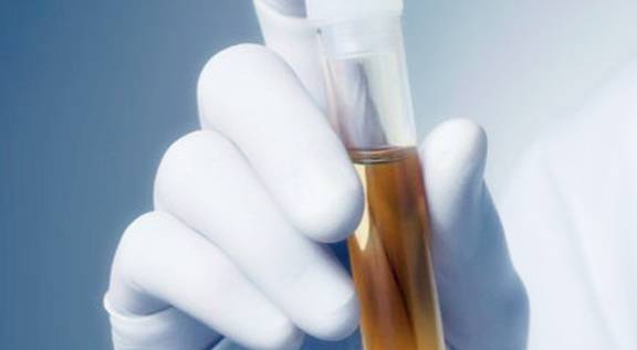 红细胞|身体如果出现这些异常的时候，最去做一个尿检，小心尿毒症找上门