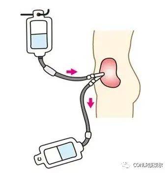 治疗|肾脏替代治疗有哪些方式？