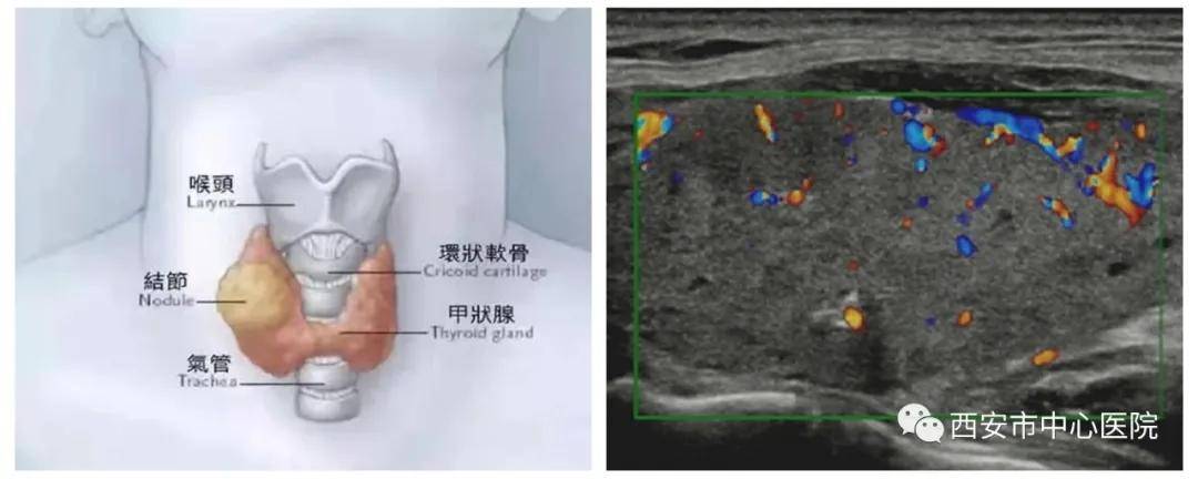 医学科|这帮彩超医师为了糖友，也是拼了！