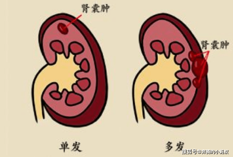 肾脏|灵魂拷问：肾囊肿切or不切？