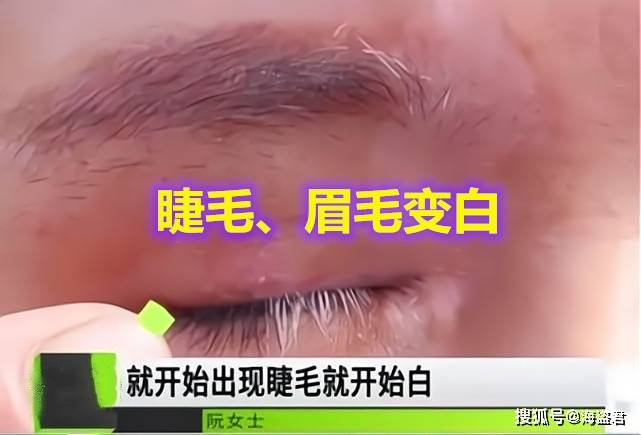 说法女子割双眼皮后变“白眉大侠”，找美容院讨要说法：是手术造成的