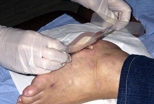 症状|二型糖尿病并发症有哪些？