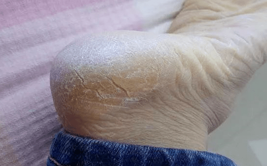 肝脏|肝脏向你求救会发出4大信号！坚持做好4个小习惯，还有的救