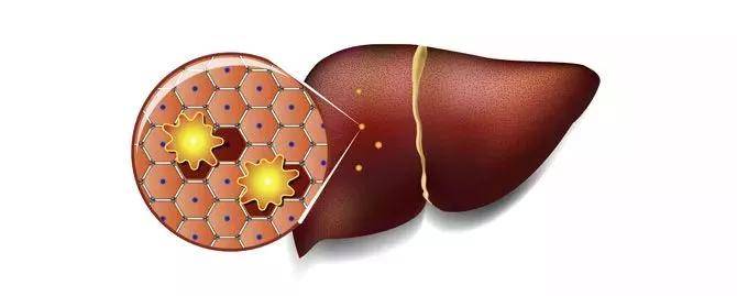 并发症|乙肝有10个并发症！日常护肝怎么做？