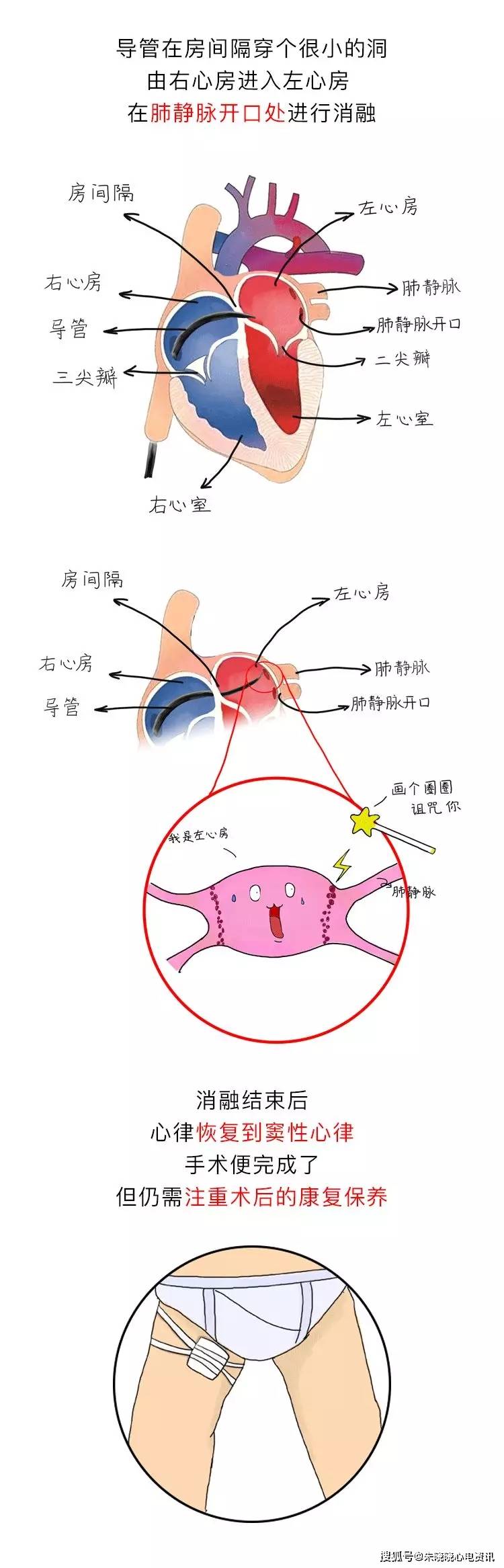 房颤|你了解房颤吗?一文图解掌握