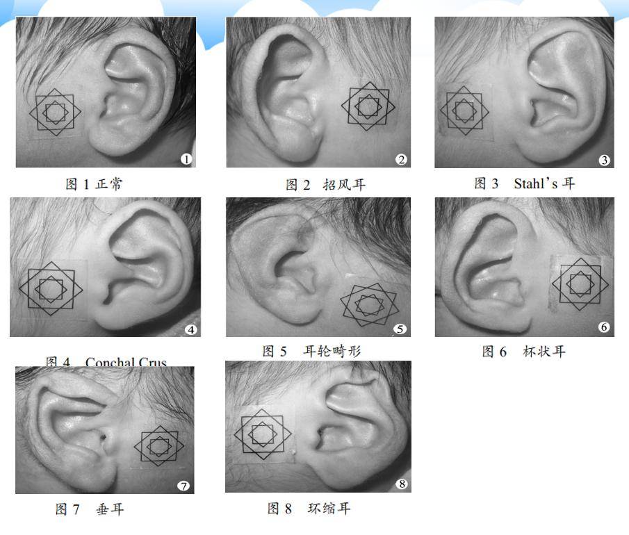 新生宝宝耳朵异常警惕耳廓畸形无创矫正宜早不宜迟
