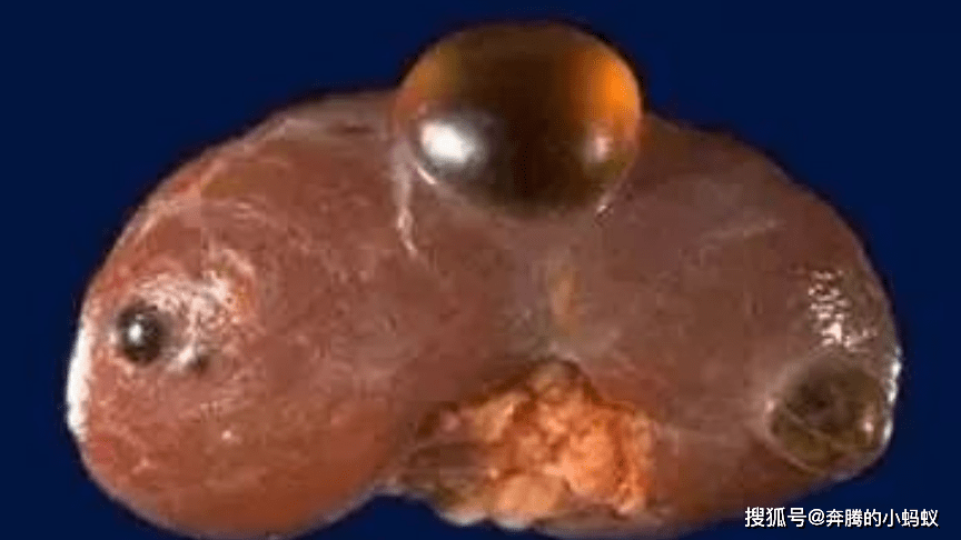 方法|腰涨腰痛可能得了肾囊肿,及时干预可轻松消除!