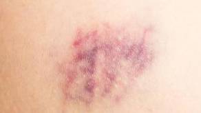 肝脏|这2个习惯是伤肝“加速器”，身体有2红、2痛，快查肝功能