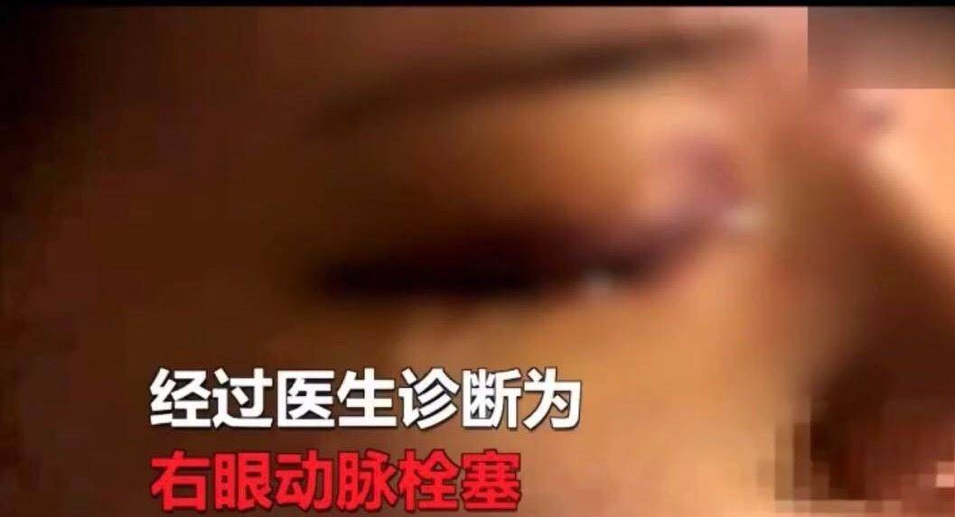 什么重庆美女做整容，一针打下去，弄瞎了一只眼