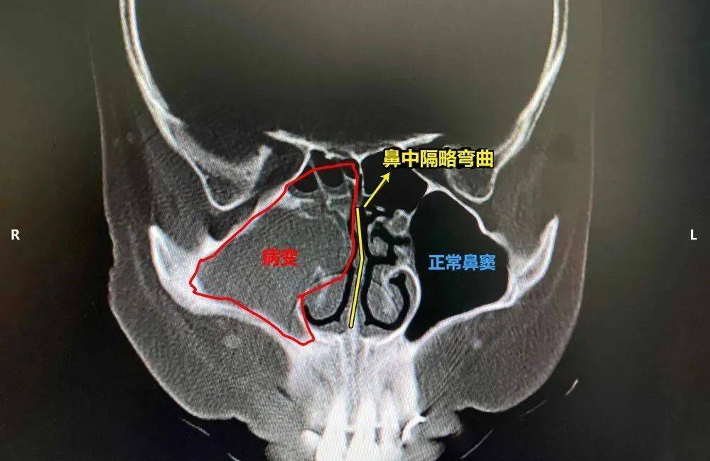 頭暈頭痛,鼻塞流涕,可能是鼻中隔偏曲的典型症狀_鼻腔_治療_患者