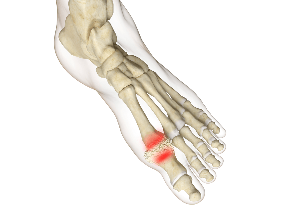 体检|体检发现尿酸升高怎么办？