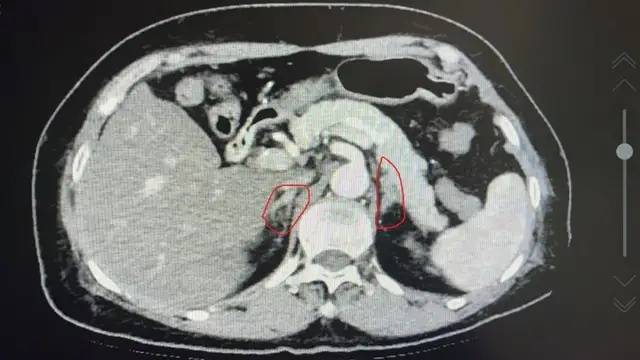 肾上腺|益阳市中心医院成功实施全市首例肾上腺静脉采血