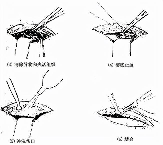 在医院中医生往往会通过清创的方式,去除腐肉