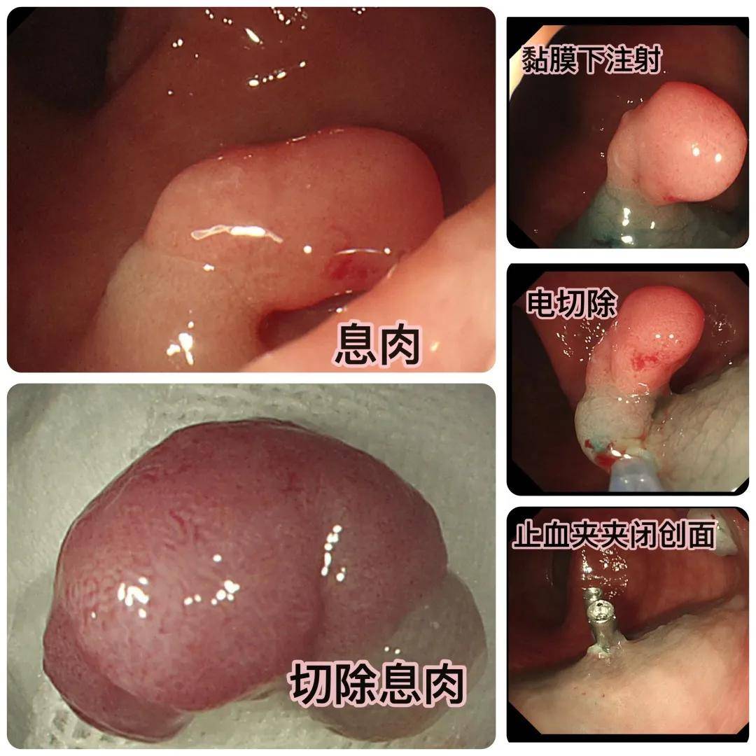 肥胖增加结直肠腺瘤,结直肠癌风险