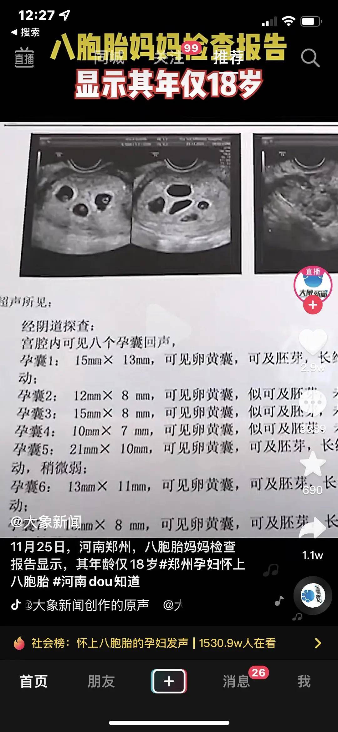 郑州八胞胎妈妈只有18岁,多胎妊娠不止加倍的喜悦,更是指数级的风险!