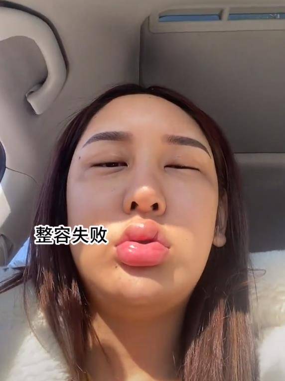 因为女网红沉迷整容却越整越难看，近照嘴巴肿成香肠嘴，承认整容失败