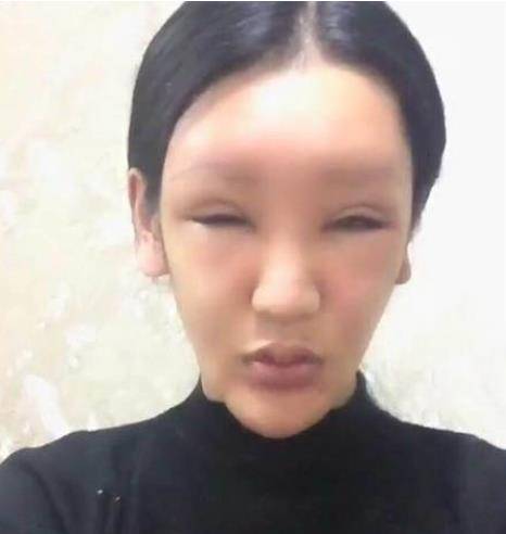 因为女网红沉迷整容却越整越难看，近照嘴巴肿成香肠嘴，承认整容失败