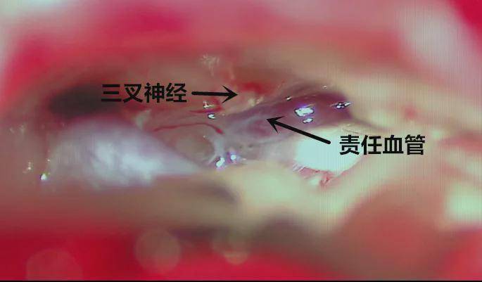 三叉神经痛病历图片