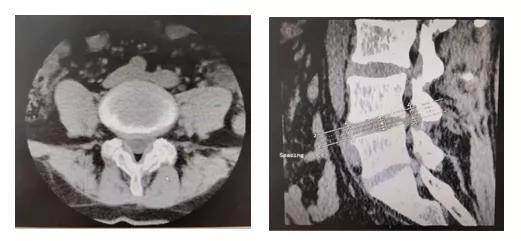 关节|影像检查｜DR&amp; CT&amp; MRI，在椎间盘疾病中如何选择呢？