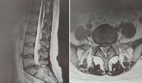 关节|影像检查｜DR&amp; CT&amp; MRI，在椎间盘疾病中如何选择呢？